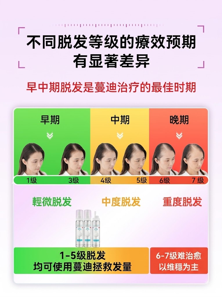 蔓迪第二代米諾地爾泡沫劑女士髪縫髮際線清爽生髮快速舒適非液