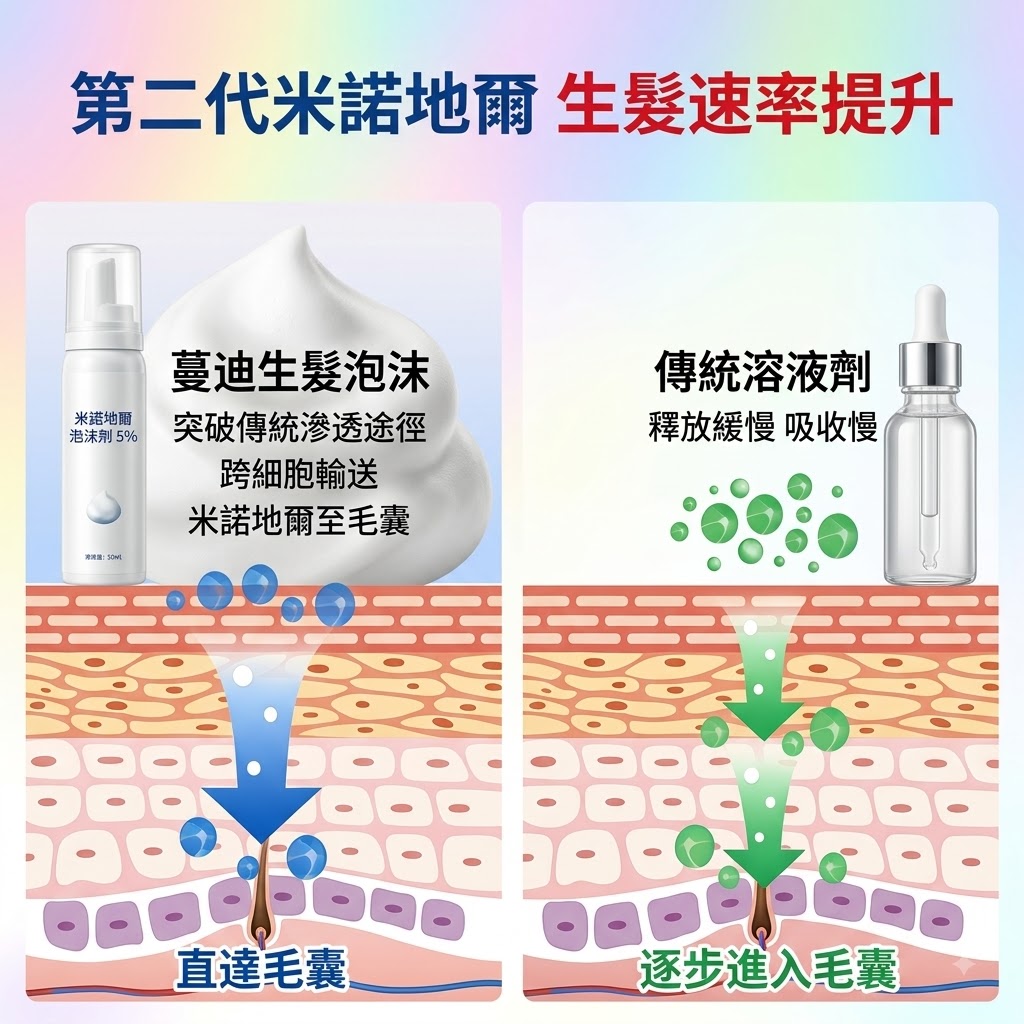 蔓迪第二代米諾地爾泡沫劑女士髪縫髮際線清爽生髮快速舒適非液