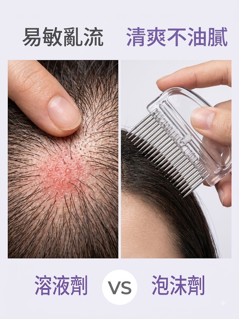 蔓迪第二代米諾地爾泡沫劑女士髪縫髮際線清爽生髮快速舒適非液