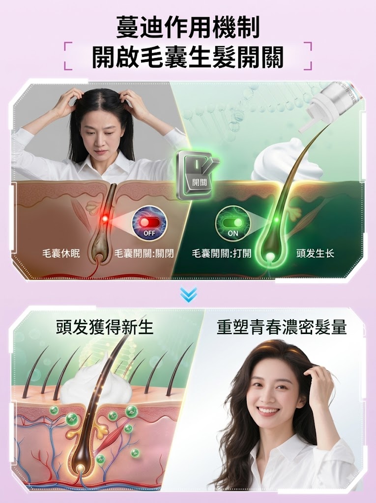 蔓迪第二代米諾地爾泡沫劑女士髪縫髮際線清爽生髮快速舒適非液