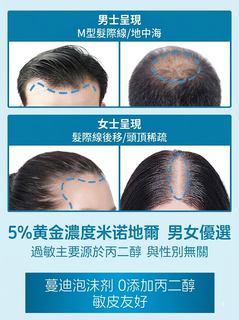 蔓迪米諾地爾泡沫劑60g曼迪生髮泡沫男性型防脫髮斑禿治脫生髮